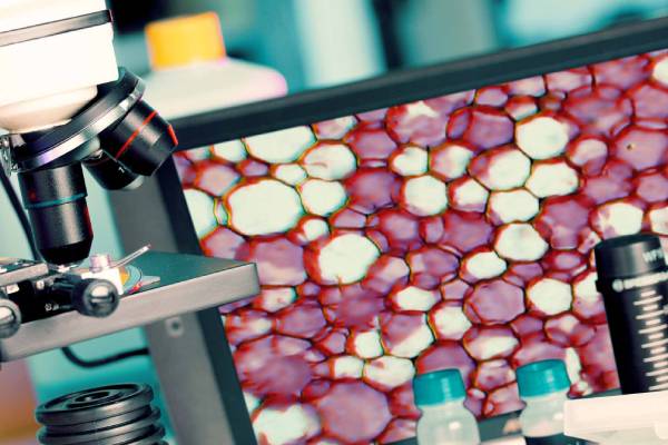A microscope kept near a tab showing result of biopsy test conducted for detection of cancer cells. 