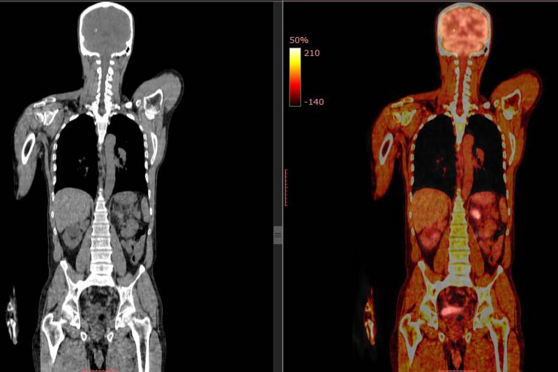Coronal view of a PET CT scan and CT scan image of a human body.