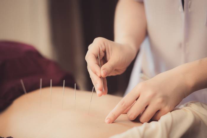 A therapist doing accupuncture along the spinal area of a patient lying down on a bed.
