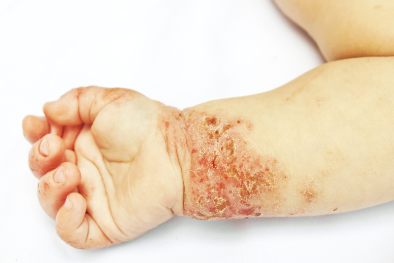 Close-up view of a baby's wrist and hand with irritated, cracked, and inflamed skin areas affected by eczema.