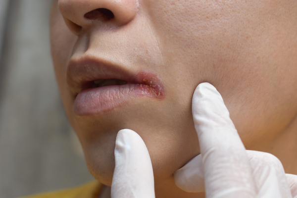 A sore on the side of the lip, which could indicate Vitamin B or iron deficiency, is examined closely by a gloved hand.