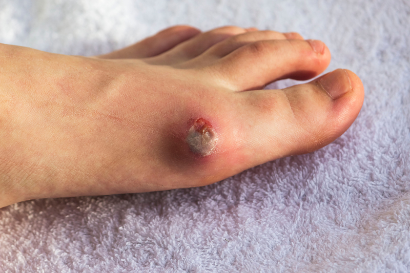 Open sores on the side of a diabetic foot, pose infection and complication risks without proper management.