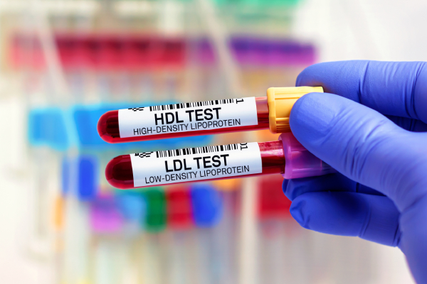 A hand -wearing blue gloves holds two test tubes for HDL and LDL cholesterol tests in a lab setting.