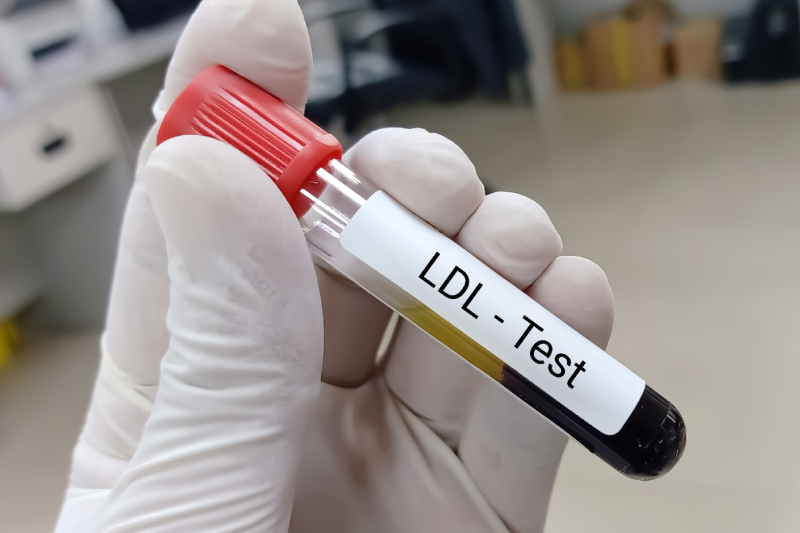 A lab technician holding a blood sample for an LDL test, indicating a type of bad cholesterol.