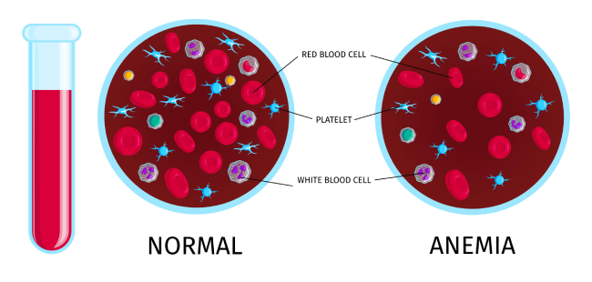 Magnified view of red blood cells in test tubes comparing anemia and normal blood samples.