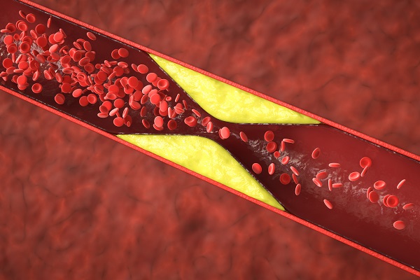 3D red blood cells showing high cholesterol buildup, leading to artery blockage and restricted blood flow.