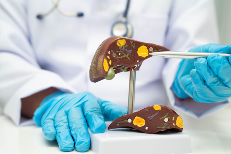 Medical professional examining a liver model to illustrate hepatitis-related liver damage.