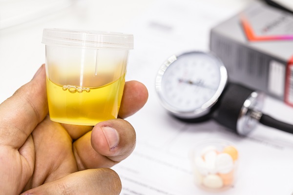 A person holding a urine sample cup and a blood pressure monitor, indicating urine tests detect kidney damage from high blood pressure.