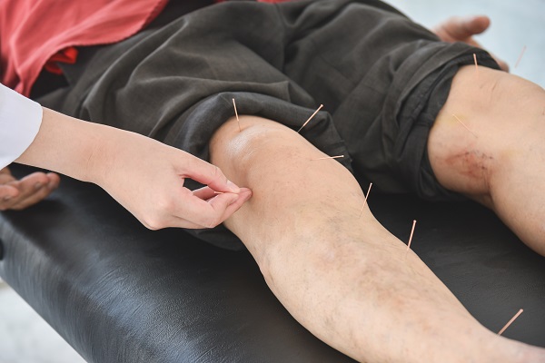 A doctor performing acupuncture on a patient's knee with multiple needles for pain relief.