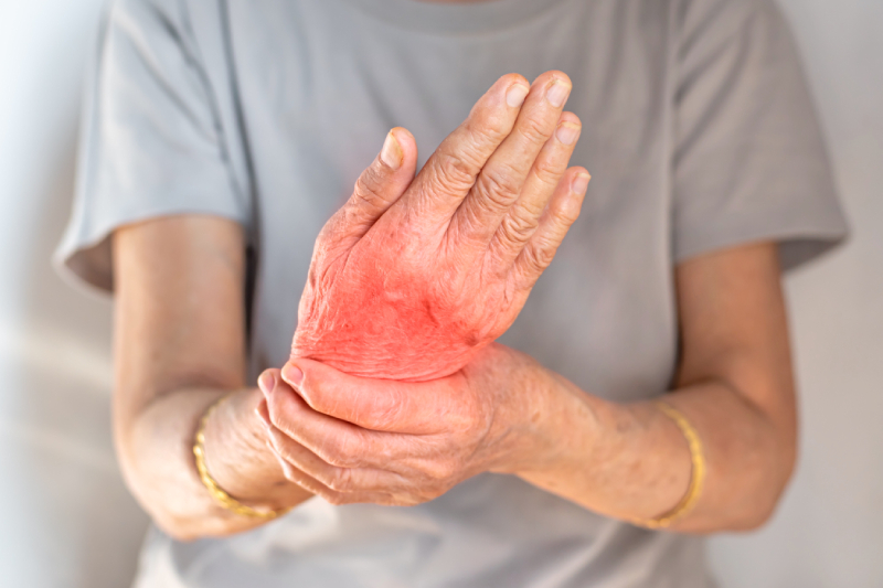 A woman’s swollen, red hand representing joint cartilage wear and tear in arthritis.