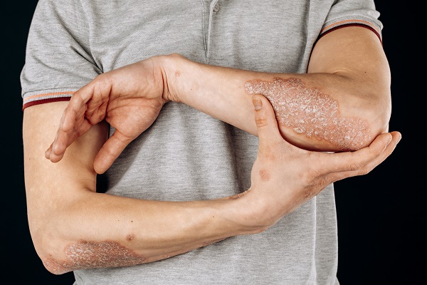 A man with red, scaly patches on his elbows and forearm, possibly due to psoriatic arthritis.