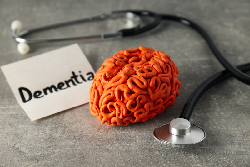 ‘Dementia’ with a stethoscope and brain model symbolizes impaired cognitive function.
