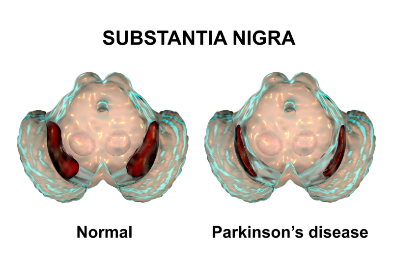 Comparison of a healthy and Parkinson’s-affected substantia nigra illustrates neuron degeneration in the brain region responsible for dopamine production.